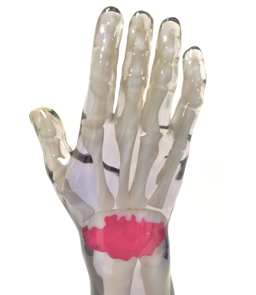 3d printed hand with fracture- medical devices